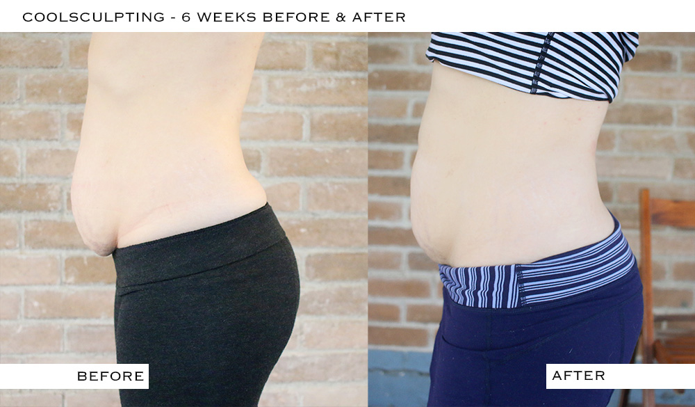 Can CoolSculpting Get Rid of My C-Section Pouch?